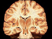 Omega 6 para enfermos de Alzheimer Omega 6 para enfermos de Alzheimer